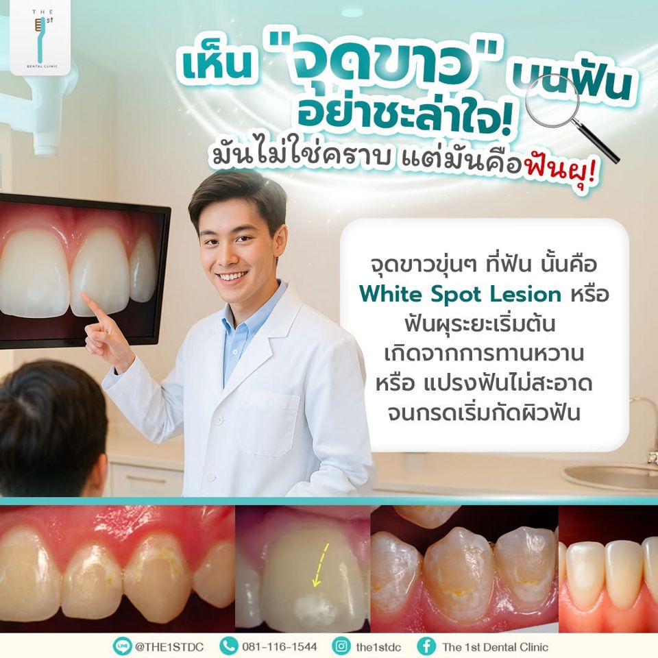 เห็นจุดขาวบนฟัน อย่าชะล่าใจ อาจเป็นฟันผุ — จุดขาวบนฟัน, White Spot Lesion, ฟันผุระยะเริ่มต้น