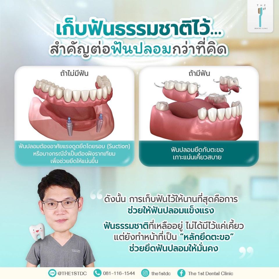 เก็บฟันธรรมชาติไว้ สำคัญต่อฟันปลอมกว่าที่คิด — หลักยึดฟันปลอม, เก็บฟันธรรมชาติ, ฟันปลอมยึดแน่น