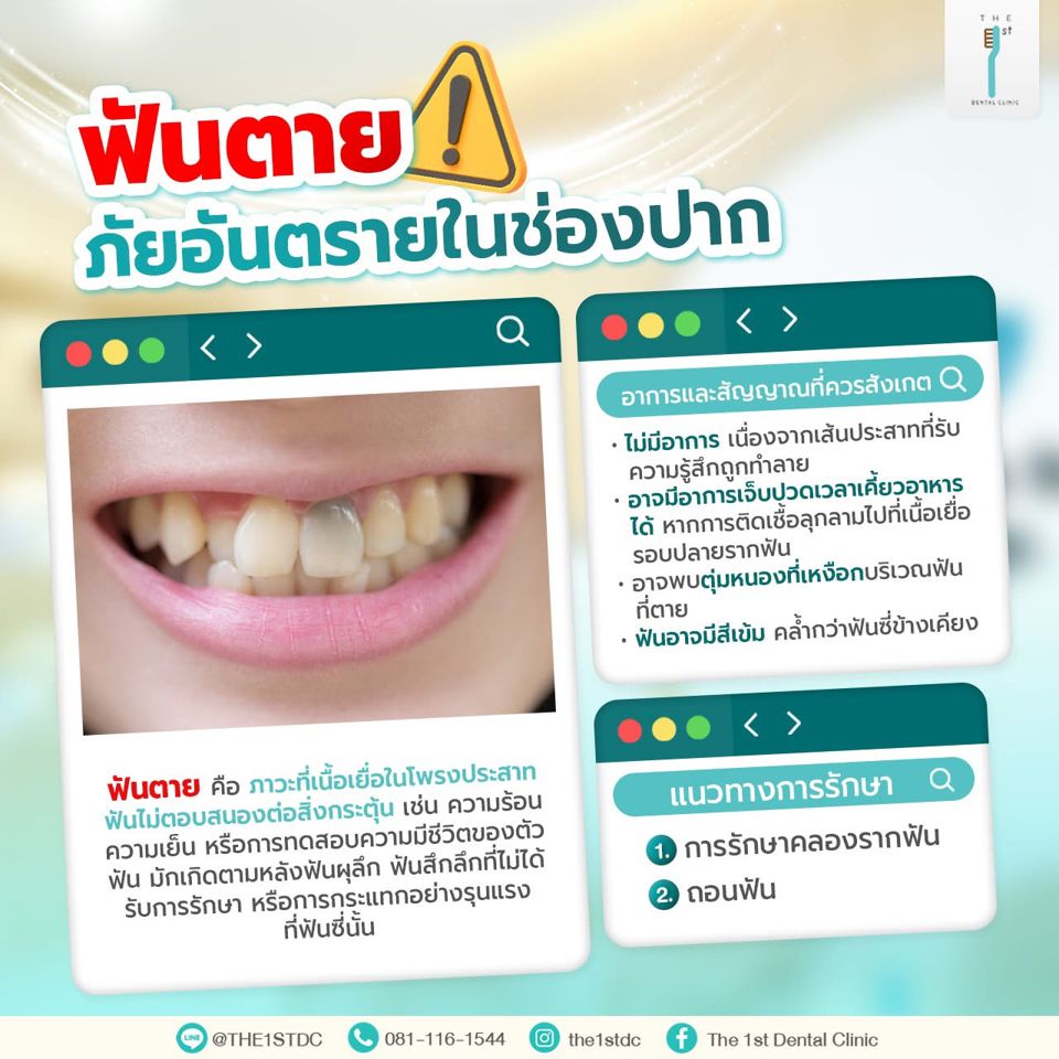 ฟันตาย ภัยอันตรายในช่องปาก — ฟันตาย, ฟันสีคล้ำ, รักษาคลองรากฟัน