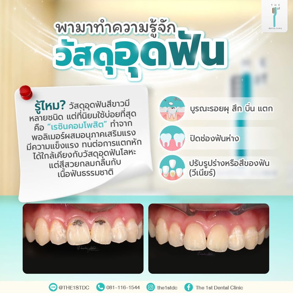 ทำความรู้จักวัสดุอุดฟัน — วัสดุอุดฟันสีขาว, เรซินคอมโพสิต, อุดฟันหน้า