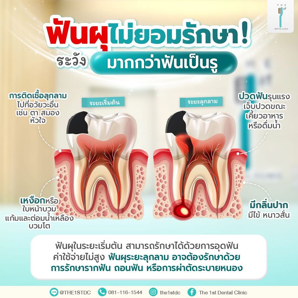 ฟันผุไม่ยอมรักษา ระวังมากกว่าฟันเป็นรู — ฟันผุลุกลาม, ปวดฟัน, ฟันผุเป็นรู