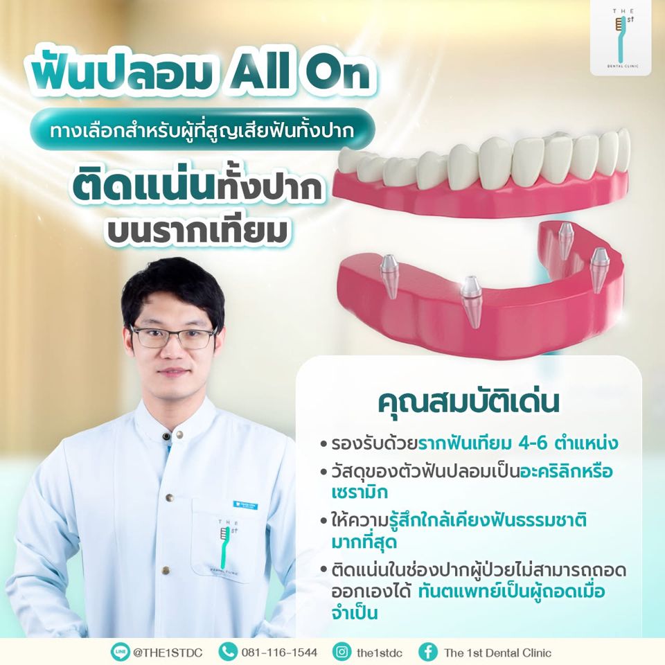 ฟันปลอม All On ติดแน่นทั้งปากบนรากเทียม — All on 4, ฟันปลอมติดแน่นทั้งปาก, รากฟันเทียม