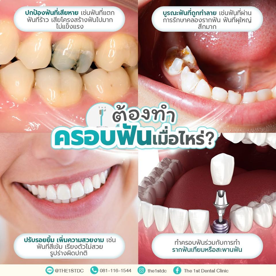 ต้องทำครอบฟันเมื่อไหร่ — ครอบฟัน, ฟันแตก ฟันร้าว, ครอบฟันหลังรักษารากฟัน