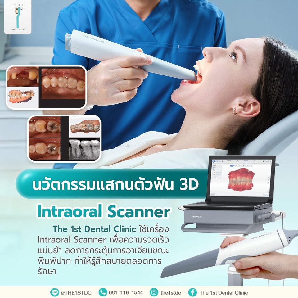 นวัตกรรมสแกนฟัน 3D Intraoral Scanner — Intraoral Scanner, สแกนฟัน 3 มิติ, พิมพ์ปากดิจิทัล