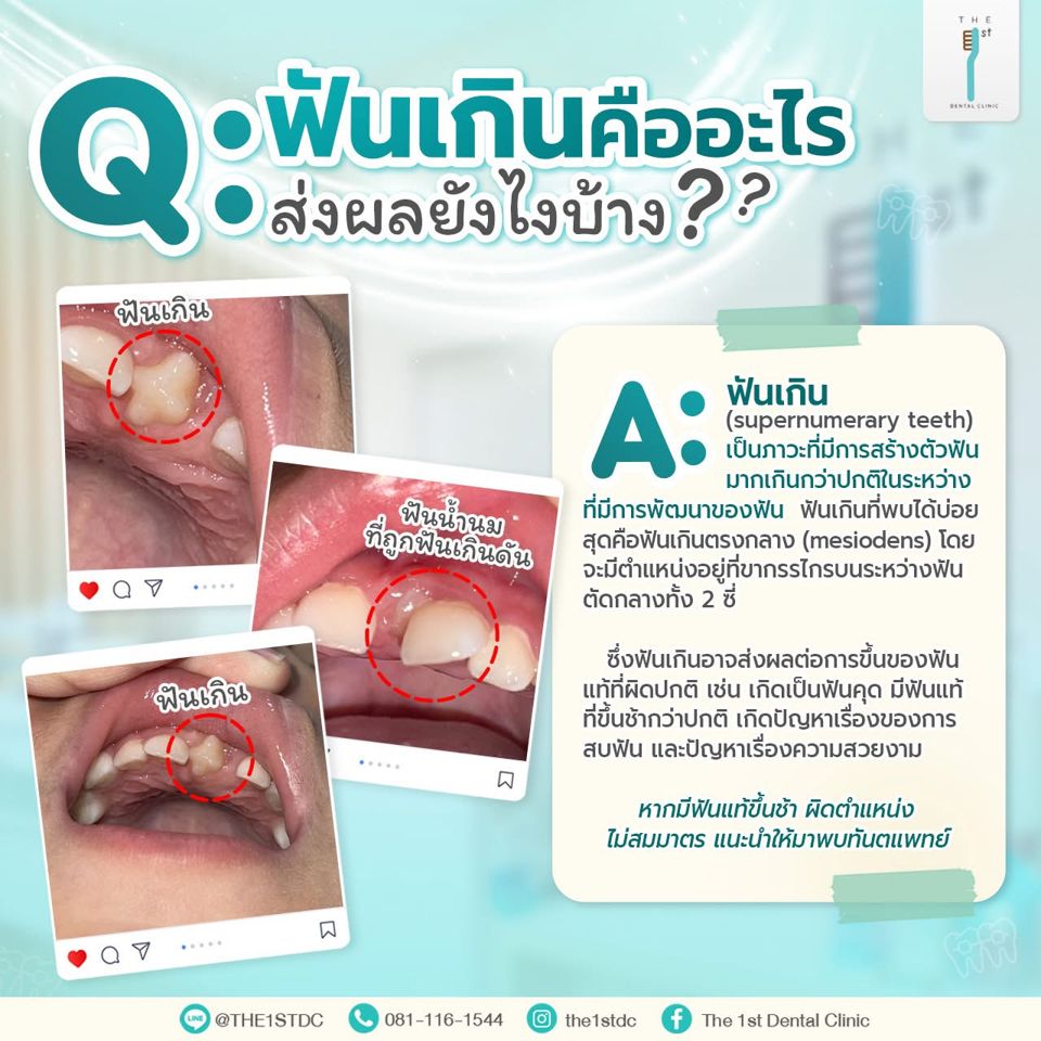 ฟันเกินคืออะไร ส่งผลอย่างไร — ฟันเกิน, Mesiodens, ฟันแท้ขึ้นช้า
