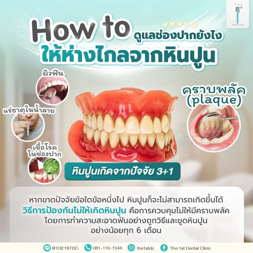 How to ดูแลช่องปากให้ห่างไกลหินปูน — หินปูน, คราบพลัค, ขูดหินปูนทุก 6 เดือน