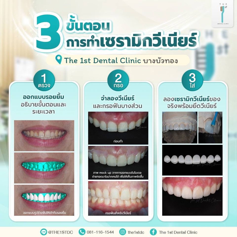 3 ขั้นตอนการทำเซรามิกวีเนียร์ — เซรามิกวีเนียร์, ขั้นตอนทำวีเนียร์, ออกแบบรอยยิ้ม