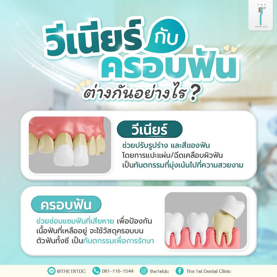 วีเนียร์กับครอบฟัน ต่างกันอย่างไร — วีเนียร์, ครอบฟัน, วีเนียร์ต่างกับครอบฟัน