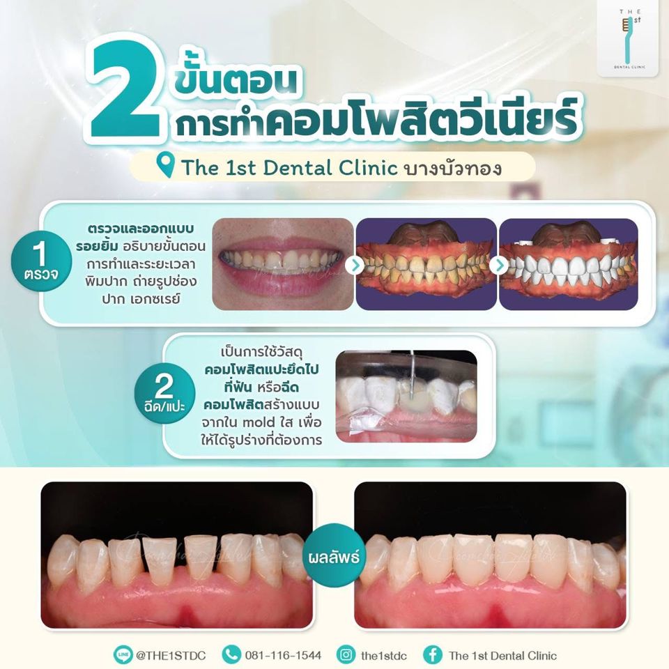 2 ขั้นตอนการทำคอมโพสิตวีเนียร์ — คอมโพสิตวีเนียร์, ปิดช่องฟันห่าง, วีเนียร์ราคาประหยัด
