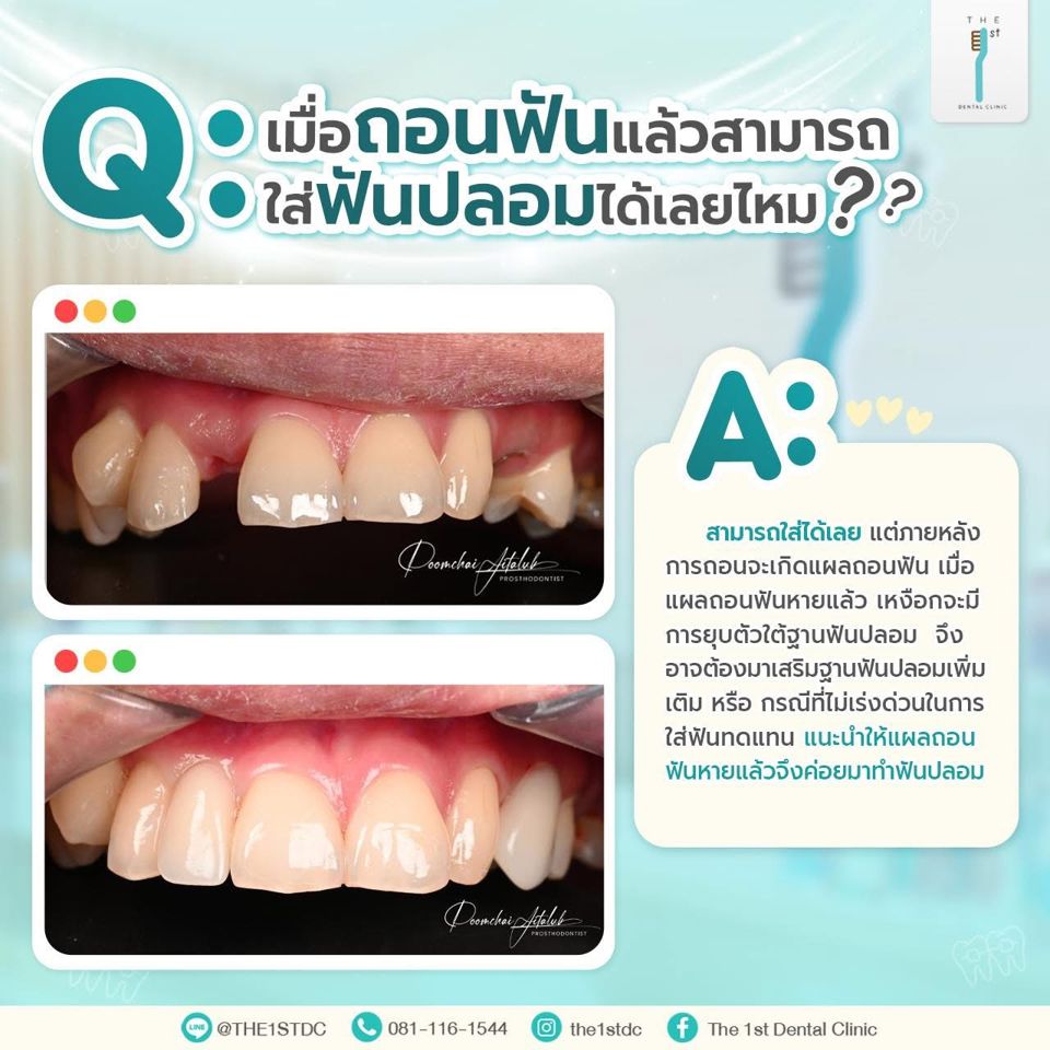 ถอนฟันแล้วใส่ฟันปลอมได้เลยไหม — ใส่ฟันปลอมหลังถอนฟัน, แผลถอนฟัน, ฟันปลอมทันที