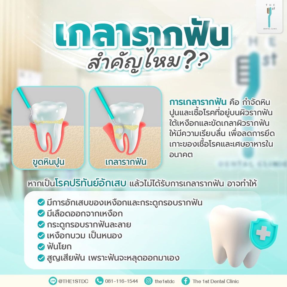 เกลารากฟัน สำคัญไหม — เกลารากฟัน, โรคปริทันต์, เหงือกอักเสบ