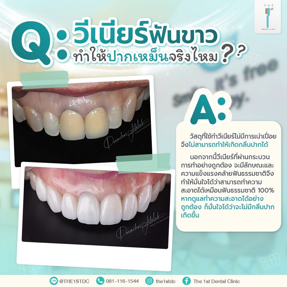 วีเนียร์ทำให้ปากเหม็นจริงไหม — วีเนียร์, กลิ่นปาก, ดูแลวีเนียร์