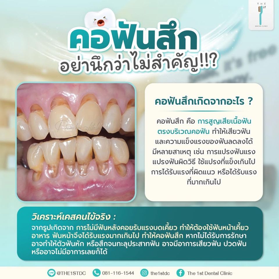 คอฟันสึก อย่านึกว่าไม่สำคัญ — คอฟันสึก, เสียวฟัน, แปรงฟันผิดวิธี