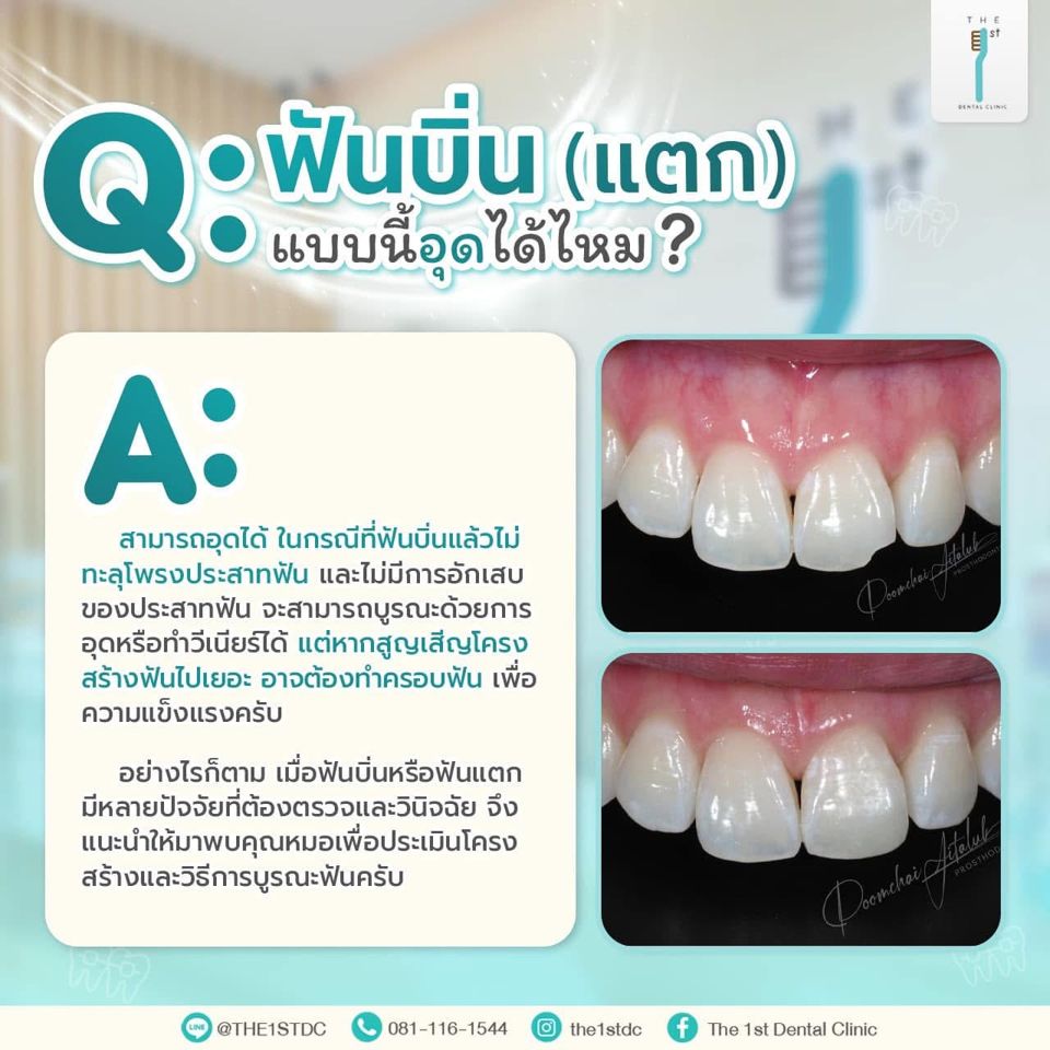 ฟันบิ่น (แตก) แบบนี้อุดได้ไหม — ฟันบิ่น, ฟันหน้าแตก, อุดฟันหน้า