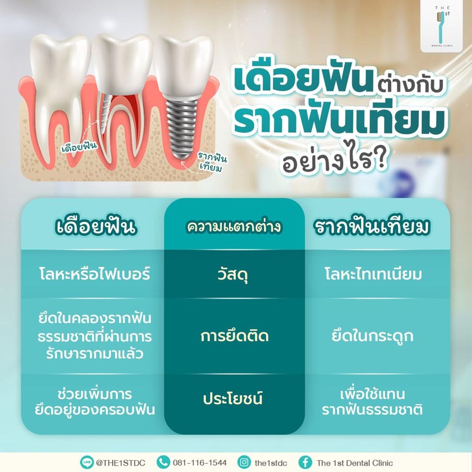 เดือยฟันต่างกับรากฟันเทียมอย่างไร — เดือยฟัน, รากฟันเทียม, ไทเทเนียม