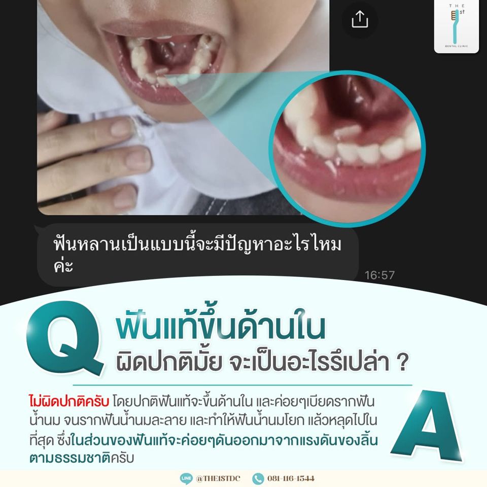 ฟันแท้ขึ้นด้านใน ผิดปกติไหม — ฟันแท้ขึ้นด้านใน, ฟันน้ำนมโยก, ฟันเด็ก