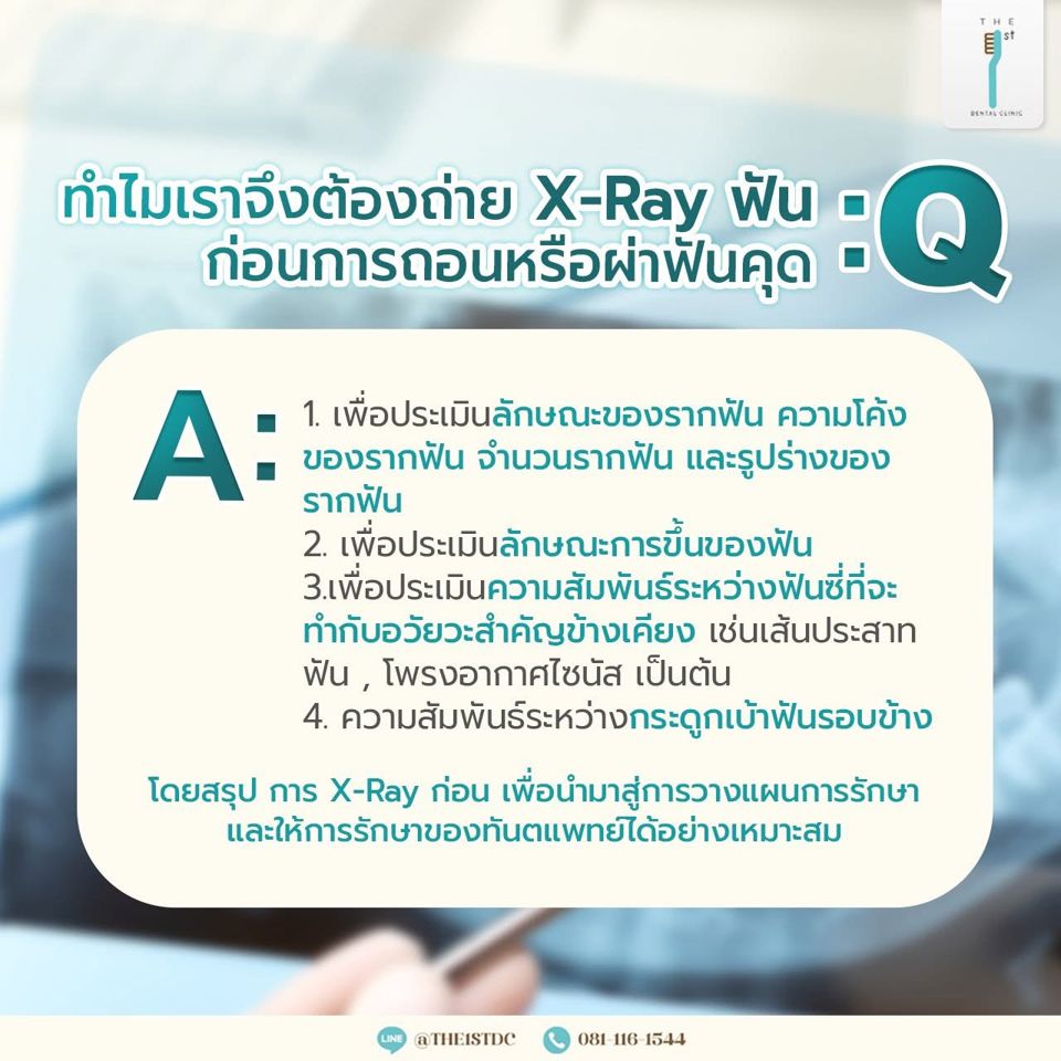 ทำไมต้อง X-Ray ฟันก่อนถอนหรือผ่าฟันคุด — เอกซเรย์ก่อนถอนฟัน, ผ่าฟันคุด, เส้นประสาทฟัน
