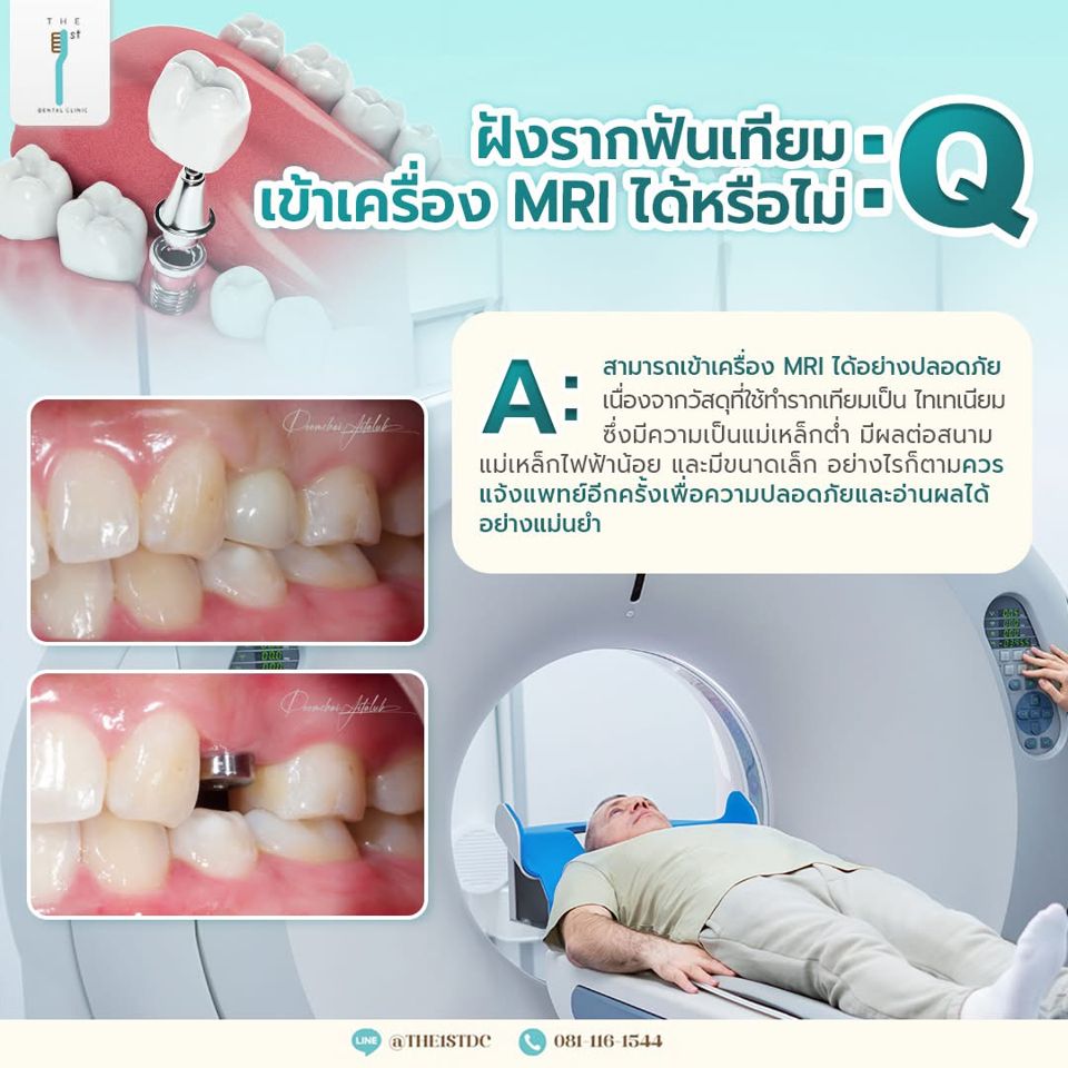 ฝังรากฟันเทียม เข้าเครื่อง MRI ได้หรือไม่ — รากฟันเทียม, MRI, ไทเทเนียม