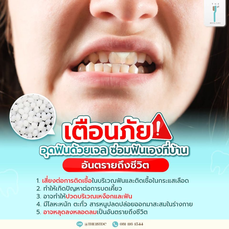 เตือนภัย อุดฟันด้วยเจล ซ่อมฟันเองที่บ้าน — อุดฟันเอง, เจลอุดฟัน, อันตรายจากการซ่อมฟันเอง