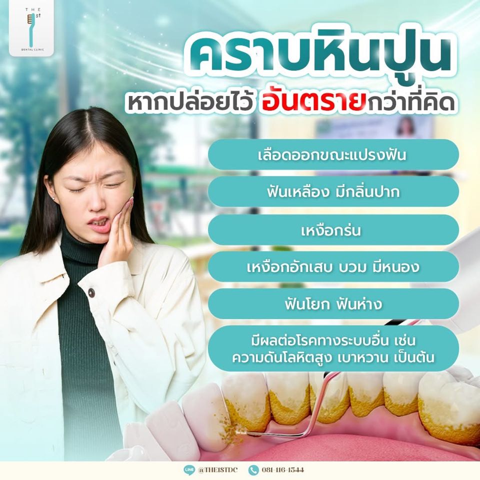 คราบหินปูน หากปล่อยไว้อันตรายกว่าที่คิด — คราบหินปูน, เลือดออกตามไรฟัน, ขูดหินปูน