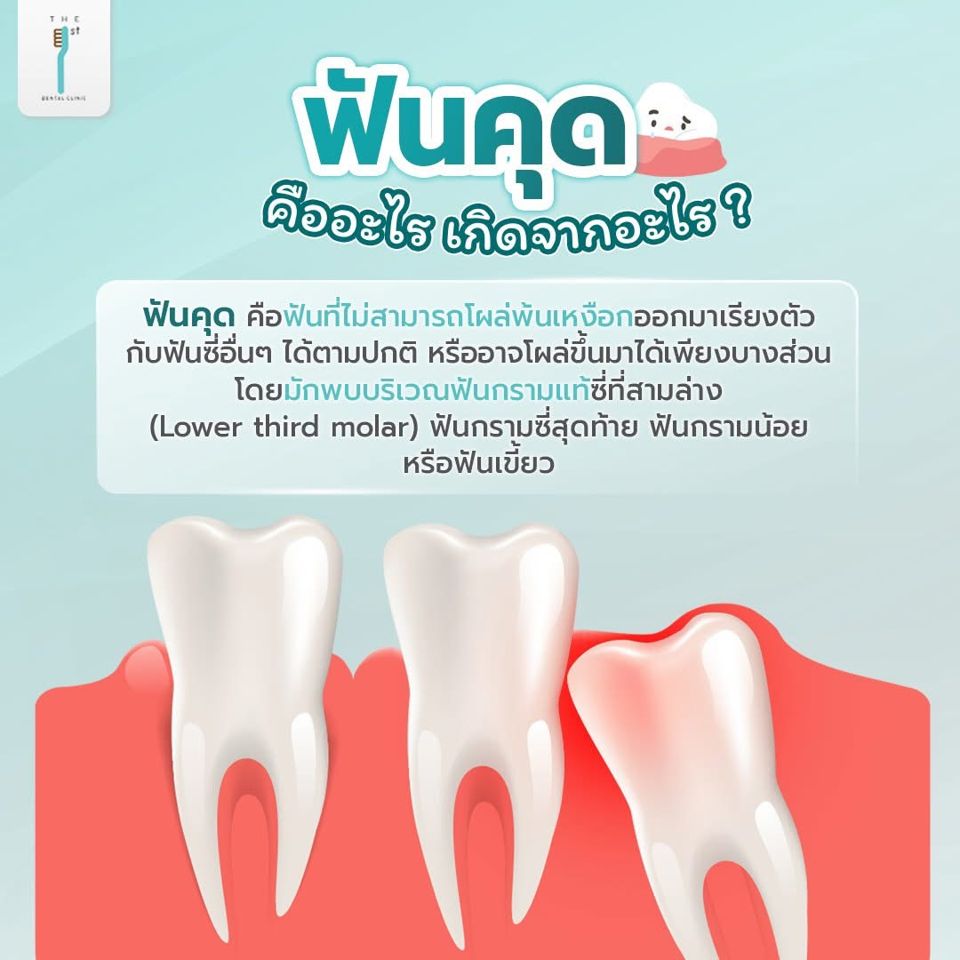 ฟันคุดคืออะไร เกิดจากอะไร — ฟันคุด, ฟันกรามซี่สุดท้าย, ผ่าฟันคุด