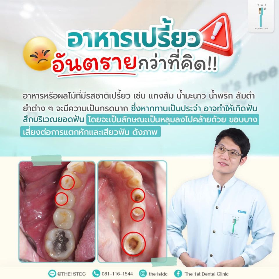 อาหารเปรี้ยว อันตรายกว่าที่คิด — อาหารเปรี้ยว, กรดกัดกร่อนฟัน, ฟันสึก