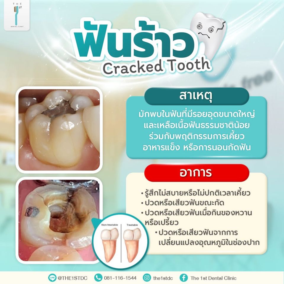 ฟันร้าว (Cracked Tooth) — ฟันร้าว, Cracked Tooth, เสียวฟันเวลากัด
